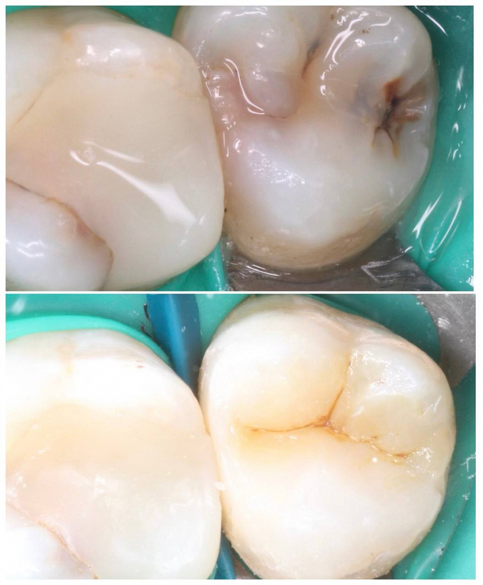 Кариес зуба мудрости